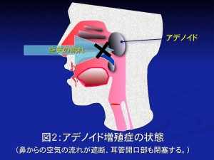 アドノイド2